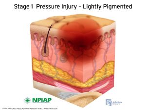 Stage 1 Pressure Injury Illustration