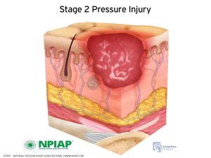Stage 2 Pressure Injury Illustration