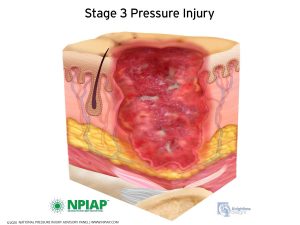 Stage 3 Pressure Injury Illustration