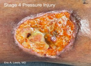 stage 4 pressure injury photo Eric Lewis MD